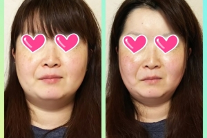 小顔美顔矯正ってどんな変化するの?